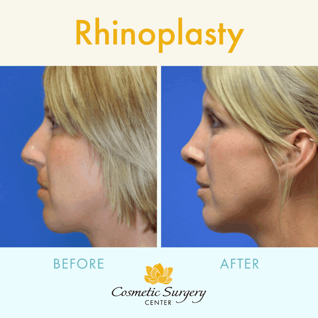 Little Rock Cosmetic Surgery Center rhinoplasty before and after results