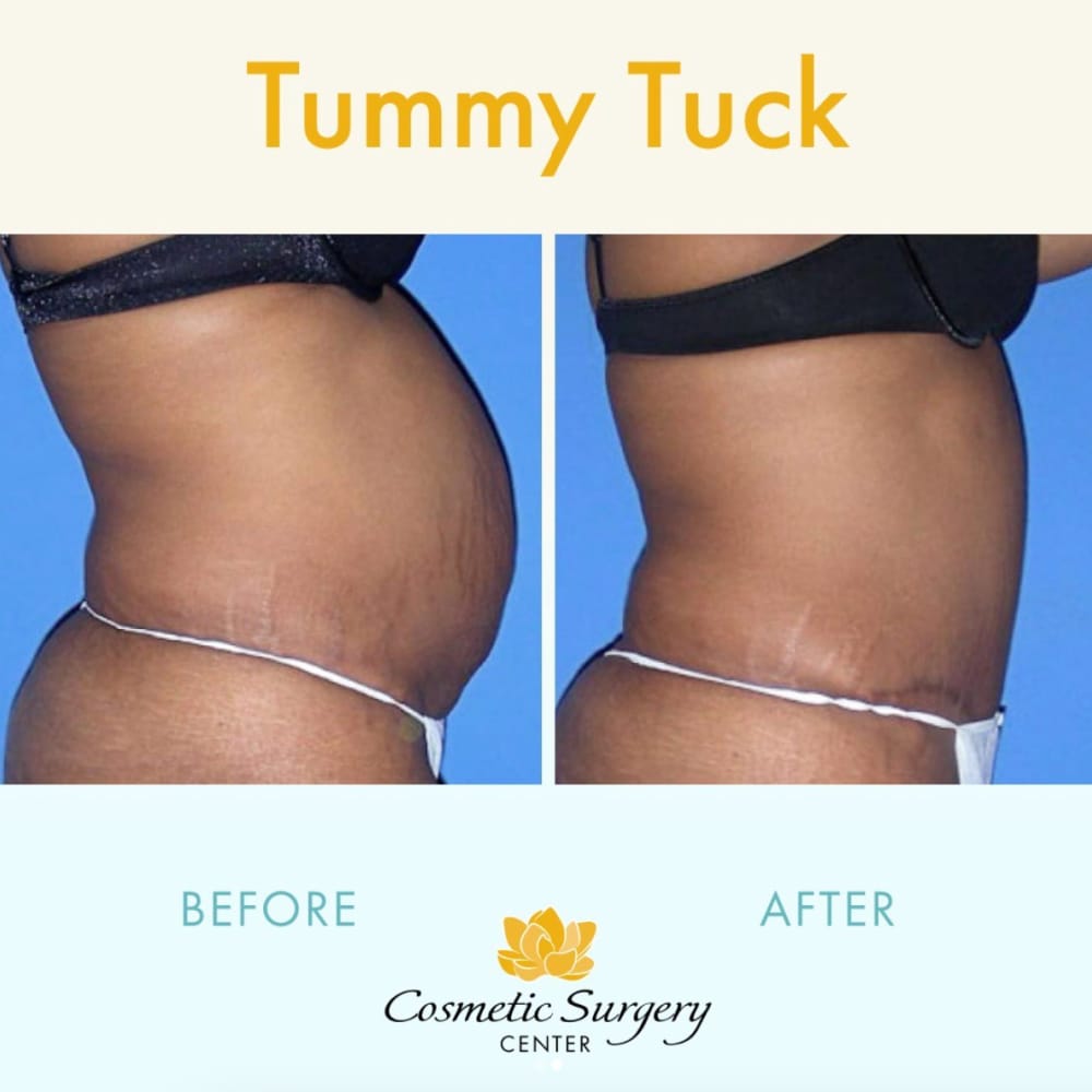 Little Rock Tummy Tuck before and after results