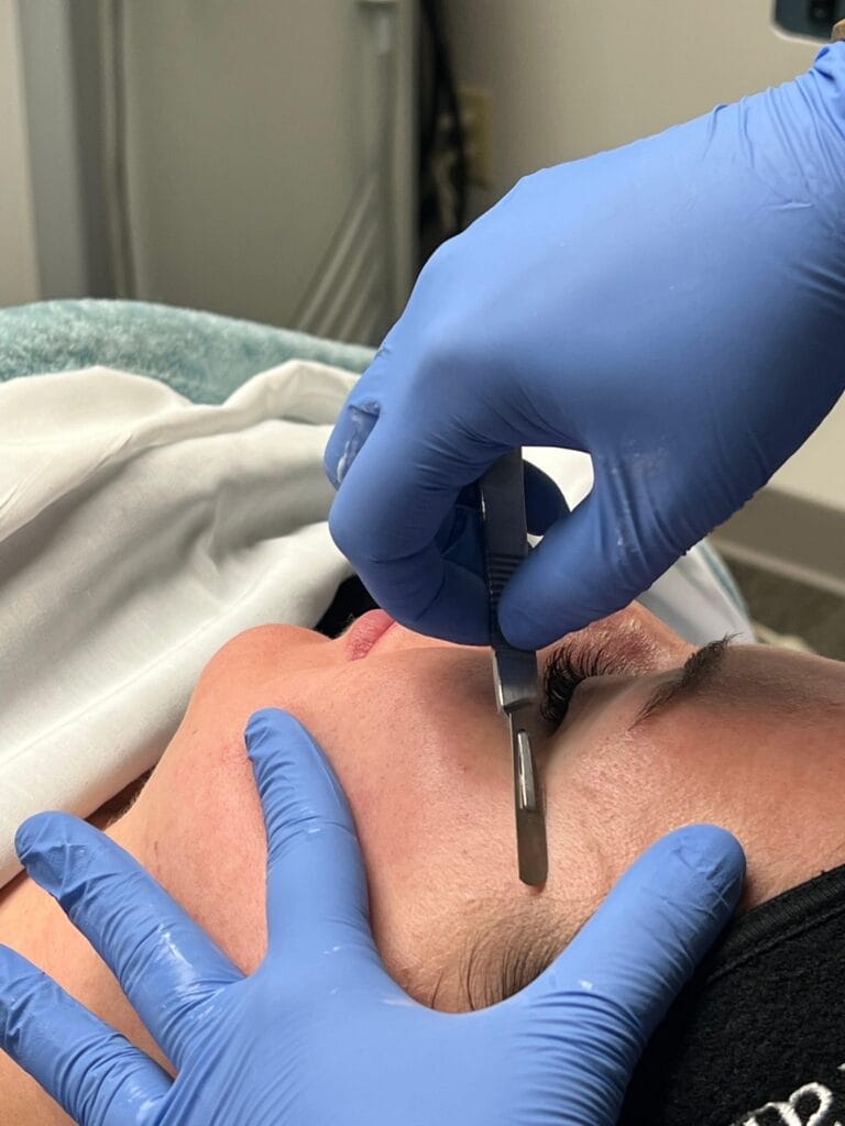 Little Rock dermaplaning treatment