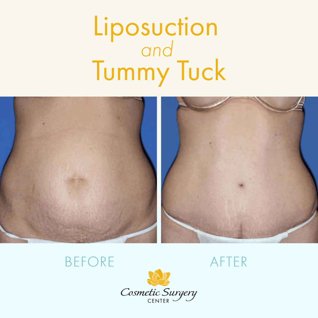 Before and after liposuction and tummy tuck in Little Rock