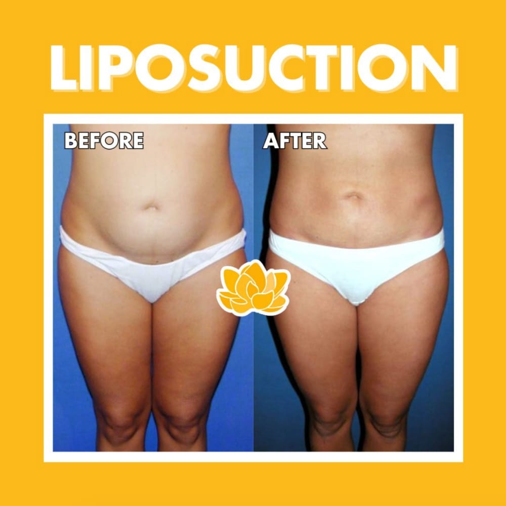 Before and after Little Rock liposuction