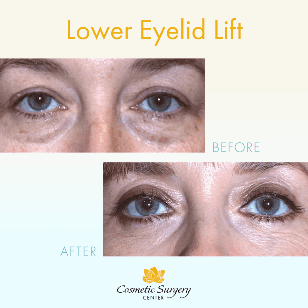Before and after lower eyelid lift surgery with Little Rock cosmetic surgeon Dr. Branman
