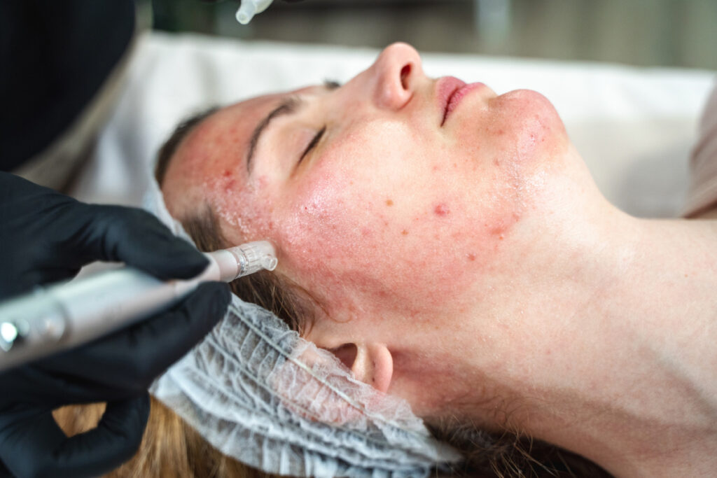 Woman getting a microneedling treatment at a med spa