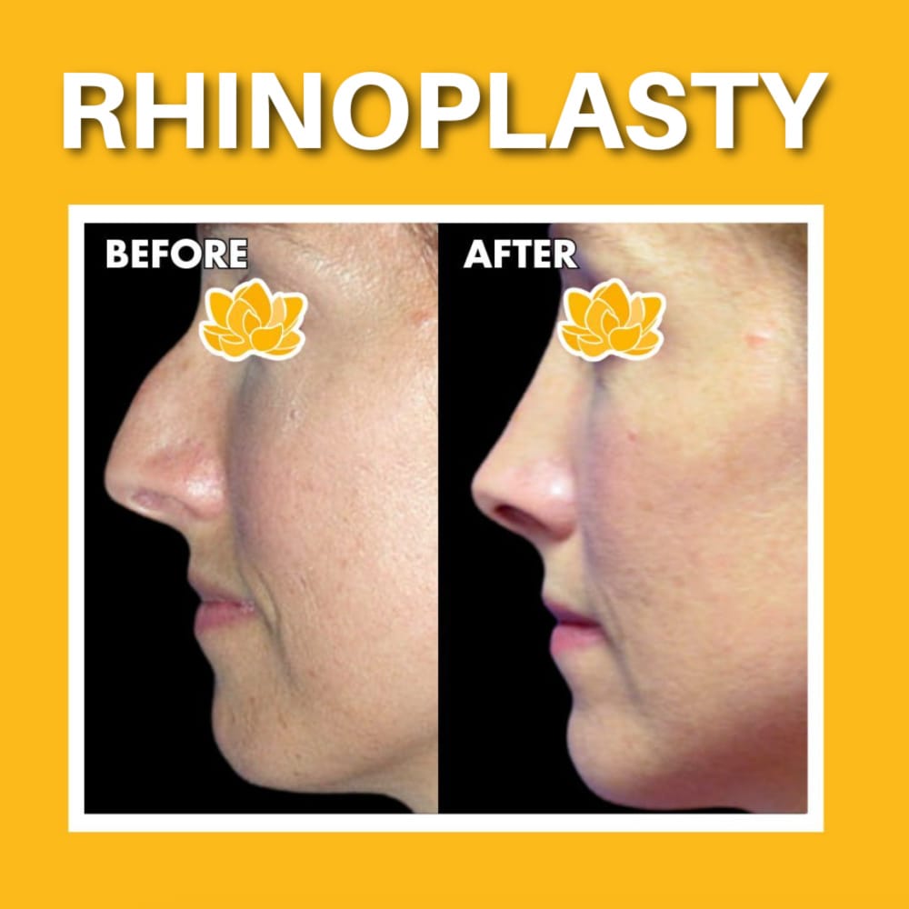 Little Rock Cosmetic Surgery Center rhinoplasty before and after results