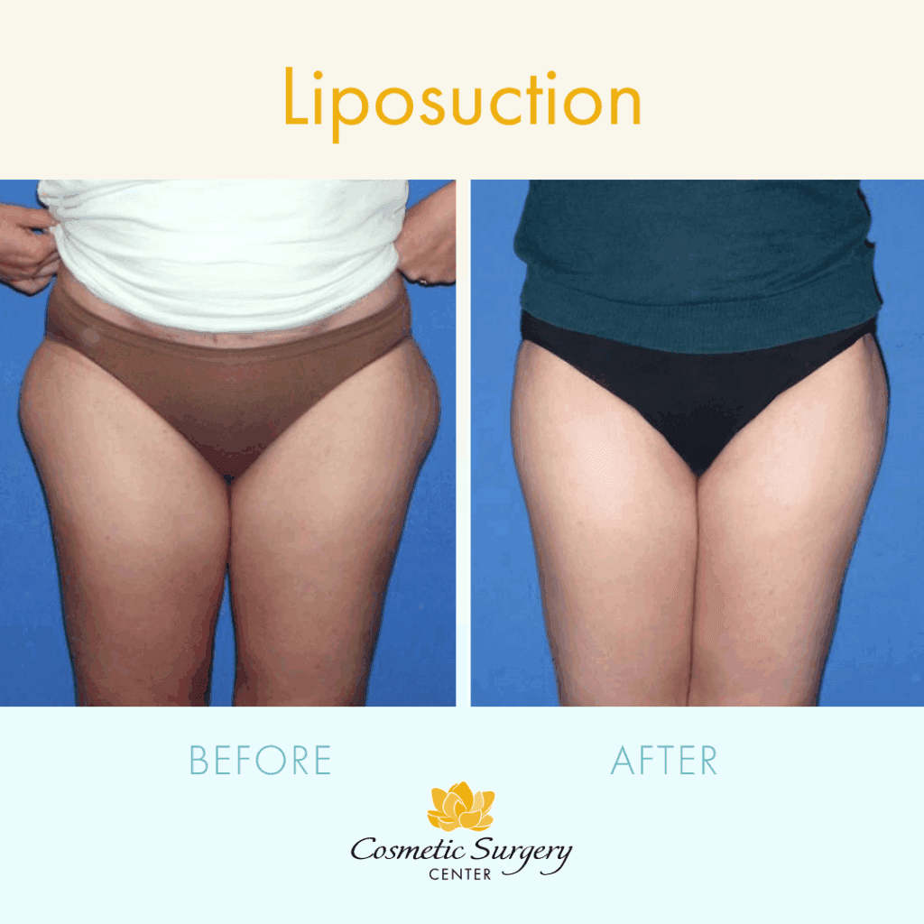 Liposuction in the outer thighs