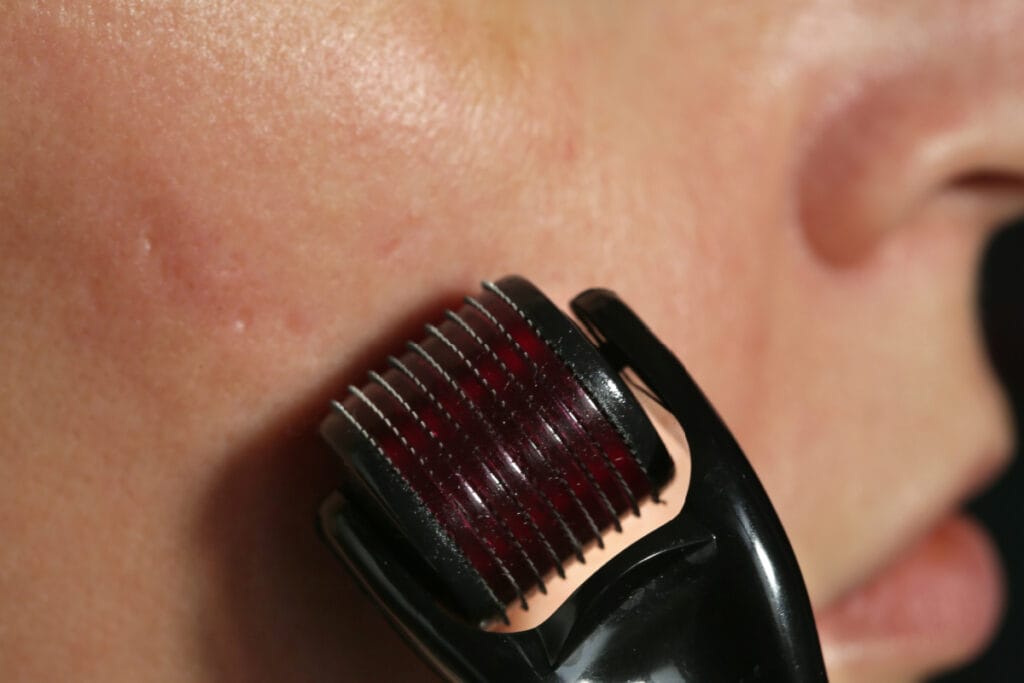 Close up of derma roller micro-needle tool on cheek skin